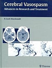 Cerebral Vasospasm: Advances in Research and Treatment (Hardcover)