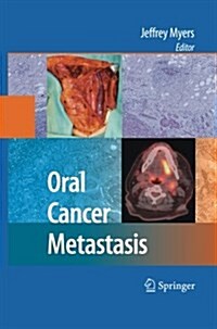 Oral Cancer Metastasis (Paperback)