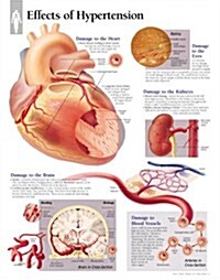 Effects of Hypertension Chart: Wall Chart (Other)