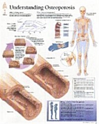 Understanding Osteoporosis Chart: Wall Chart (Other)