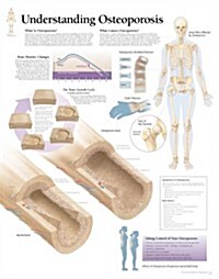 Understanding Osteoporosis Chart: Laminated Wall Chart (Other)