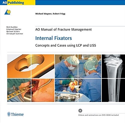 Ao Manual of Fracture Management: Internal Fixators: Concepts and Cases Using Lcp/Liss (Hardcover)