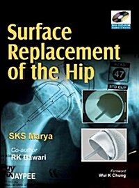 Surface Replacement of the Hip (Hardcover)