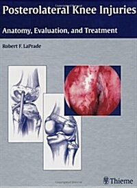 Posterolateral Knee Injuries : Anatomy, Evaluation, and Treatment (Hardcover)