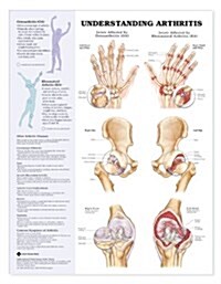 Osteoarthritis and Rheumatoid Arthritis Anatomical Chart (Chart)