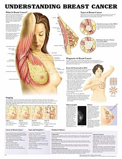 Understanding Breast Cancer Anatomical Chart (Chart, Wall)