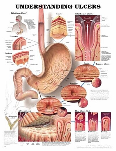 Understanding Uclers Chart (Chart, 1st)