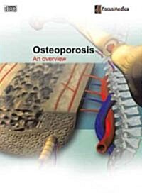 Osteoporosis (CD-ROM)