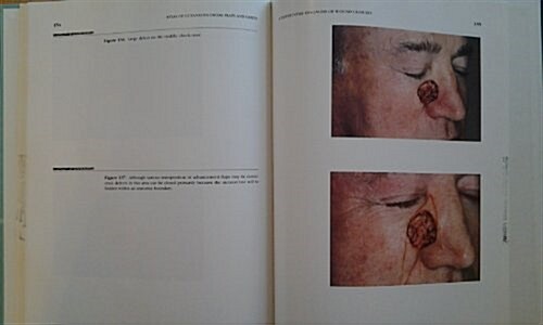 Atlas of Cutaneous Facial Flaps and Grafts: A Differential Diagnosis of Wound Closures (Hardcover)