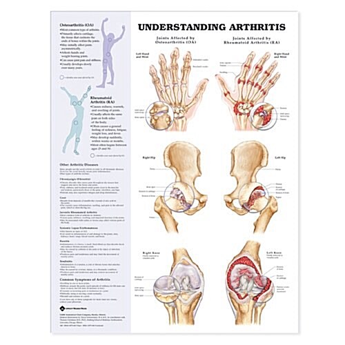 Arthritis Joint Inflammation Anatomical Chart (Chart)