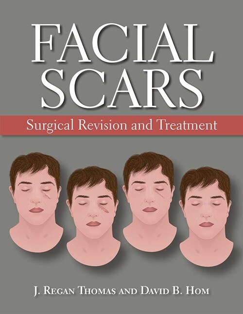 Facial Scars : Surgical Revision and Treatment (Hardcover)