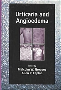 Urticaria and Angioedema (Hardcover)