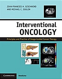 Interventional Oncology : Principles and Practice of Image-Guided Cancer Therapy (Hardcover, 2 Revised edition)