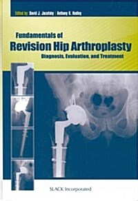 Fundamentals of Revision Hip Arthroplasty: Diagnosis, Evaluation, and Treatment (Hardcover)