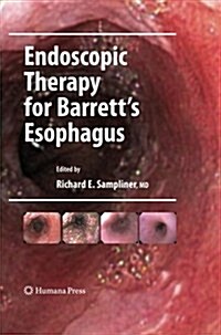 Endoscopic Therapy for Barretts Esophagus (Paperback)