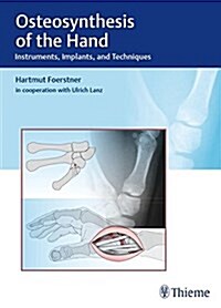 Osteosynthesis of the Hand: Instruments, Implants, and Techniques (Hardcover)