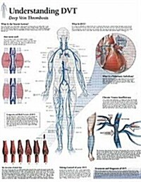 Understanding Dvt Chart: Laminated Wall Chart (Other)