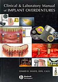 Clinical and Laboratory Manual of Implant Overdentures (Hardcover)