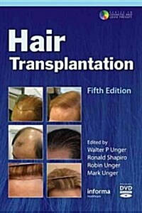 Hair Transplantation (Hardcover, 5)