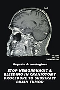 Stop Hemorrhagic & Bleeding in Craniotomy Procedure to Substract Brain Tumor (Paperback)